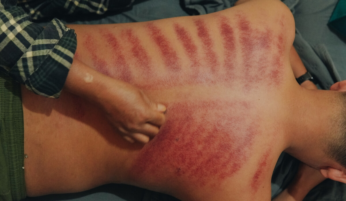 刮痧、拔罐、溫罐適用的放鬆情境不同